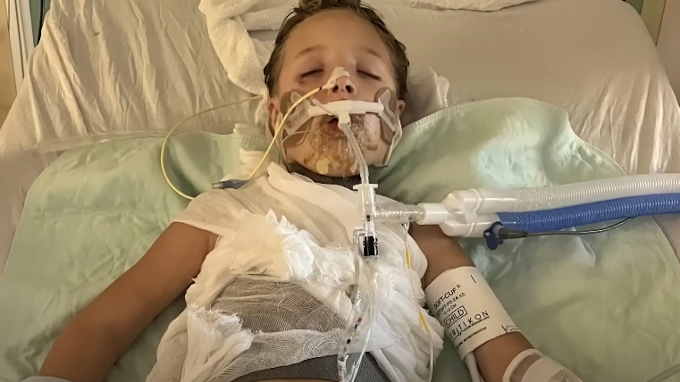 Girl who got burned after microwaving popular squishy toy